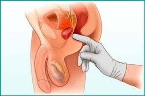 Palpation der Prostata