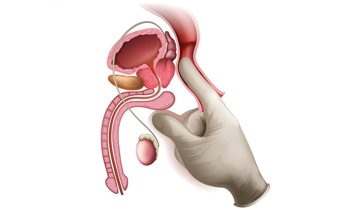Prostatamassage bei Prostatitis