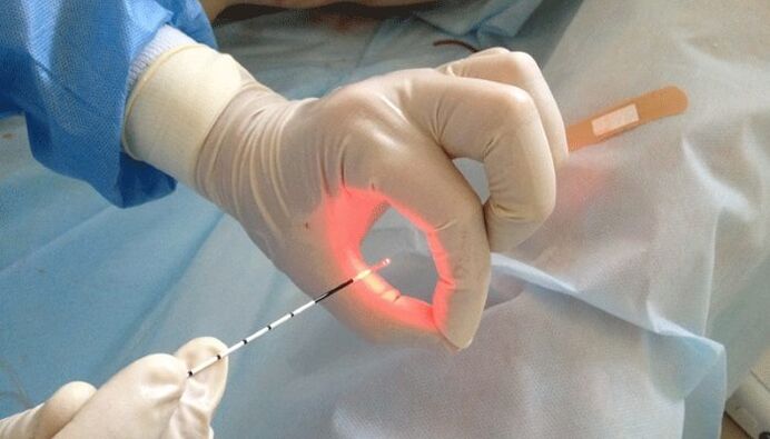 Laserbehandlung bei Prostatitis