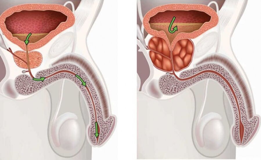 gesunde und erkrankte Prostata bei Männern