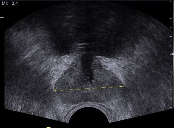 gesunde Prostata im Ultraschall nach Einnahme von Predstonorm